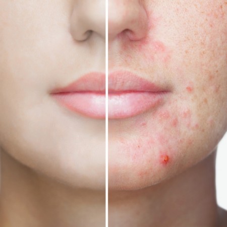 Guide to Acne Prone Skin
